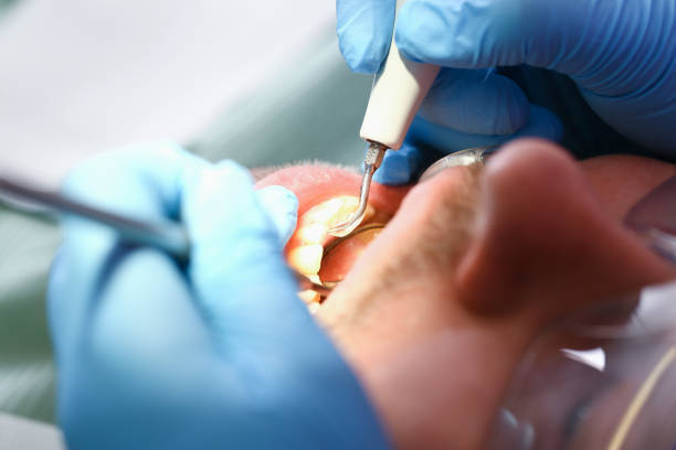 Best Emergency Dentist for Knocked-Out Tooth in Maywood Park, OR
